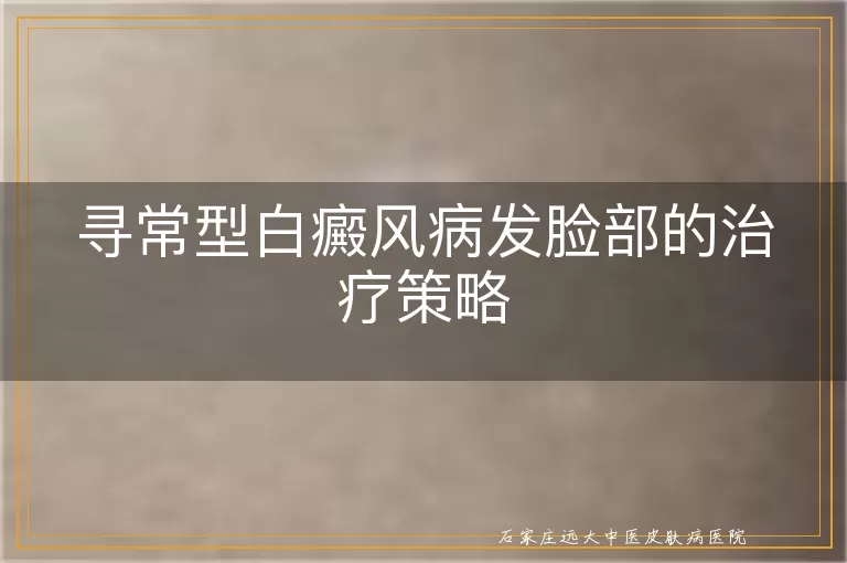寻常型白癜风病发脸部的治疗策略