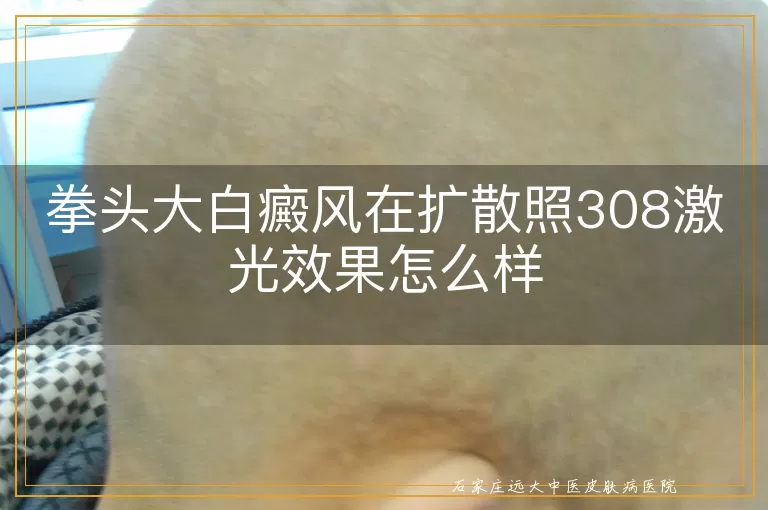 拳头大白癜风在扩散照308激光效果怎么样