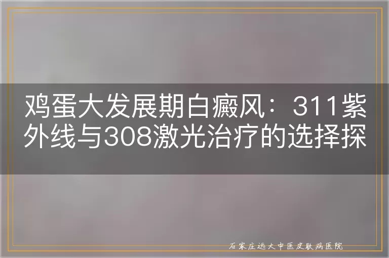 鸡蛋大发展期白癜风：311紫外线与308激光治疗的选择探讨