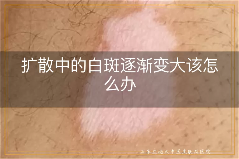 扩散中的白斑逐渐变大该怎么办