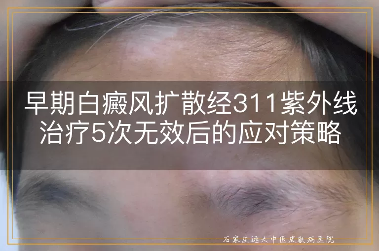 早期白癜风扩散经311紫外线治疗5次无效后的应对策略