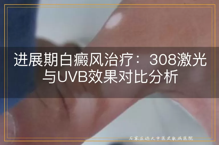 进展期白癜风治疗：308激光与UVB效果对比分析
