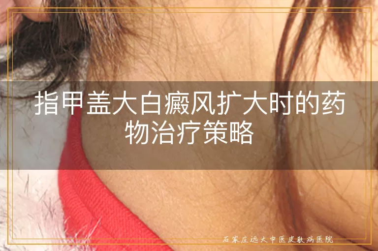 指甲盖大白癜风扩大时的药物治疗策略