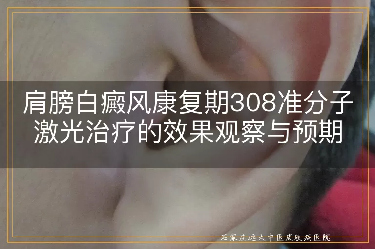 肩膀白癜风康复期308准分子激光治疗的效果观察与预期