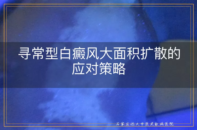 寻常型白癜风大面积扩散的应对策略