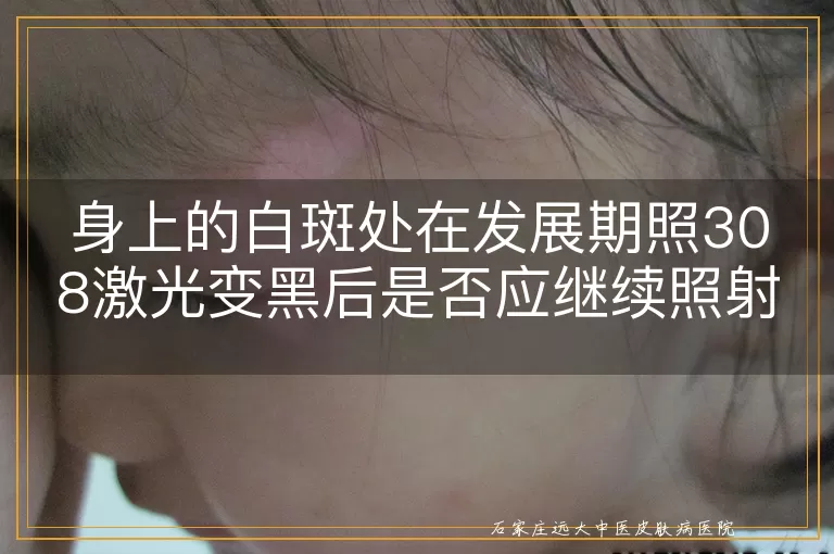 身上的白斑处在发展期照308激光变黑后是否应继续照射？