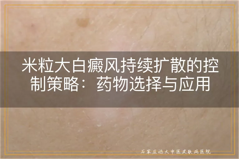 米粒大白癜风持续扩散的控制策略：药物选择与应用