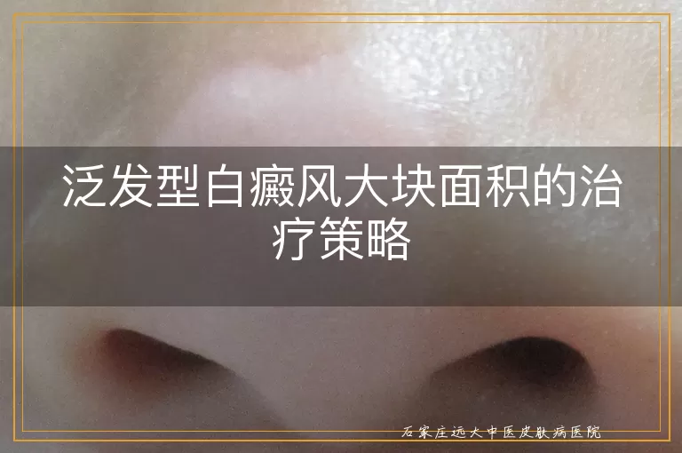 泛发型白癜风大块面积的治疗策略