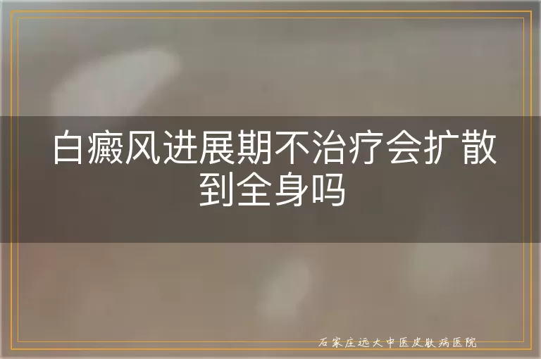 白癜风进展期不治疗会扩散到全身吗