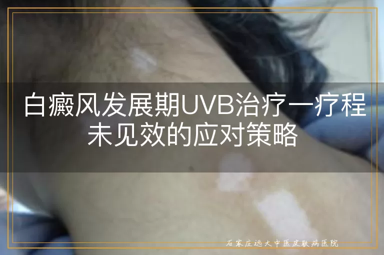 白癜风发展期UVB治疗一疗程未见效的应对策略