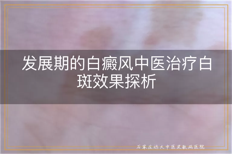 发展期的白癜风中医治疗白斑效果探析