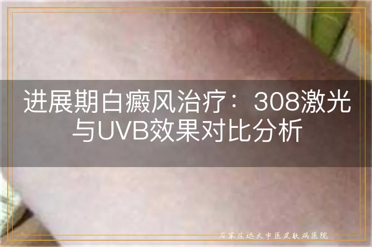 进展期白癜风治疗：308激光与UVB效果对比分析