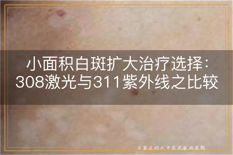 小面积白斑扩大治疗选择：308激光与311紫外线之比较