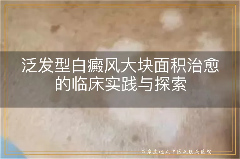 泛发型白癜风大块面积治愈的临床实践与探索