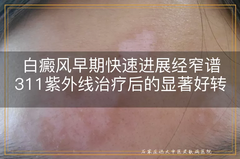 白癜风早期快速进展经窄谱311紫外线治疗后的显著好转