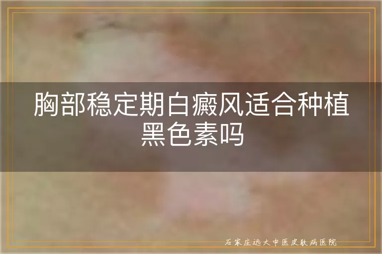 胸部稳定期白癜风适合种植黑色素吗