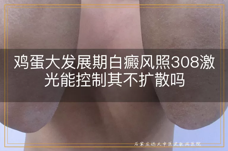鸡蛋大发展期白癜风照308激光能控制其不扩散吗