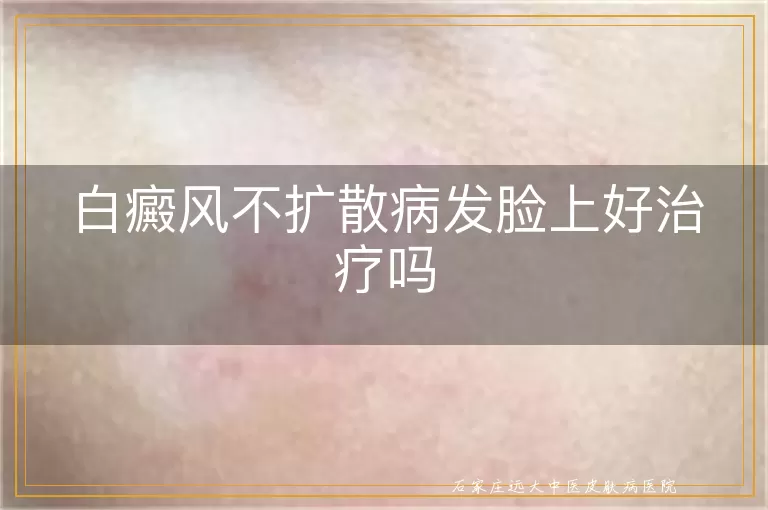 白癜风不扩散病发脸上好治疗吗