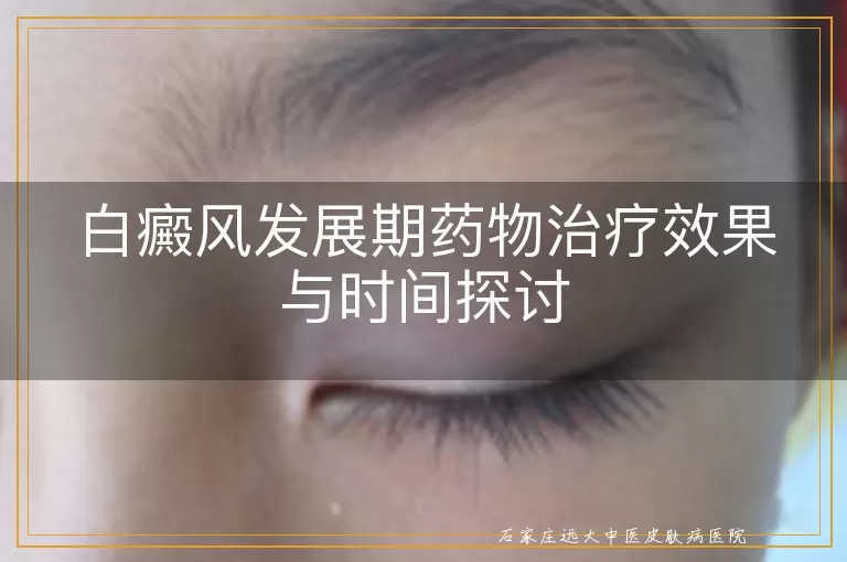 白癜风发展期药物治疗效果与时间探讨
