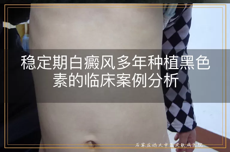稳定期白癜风多年种植黑色素的临床案例分析