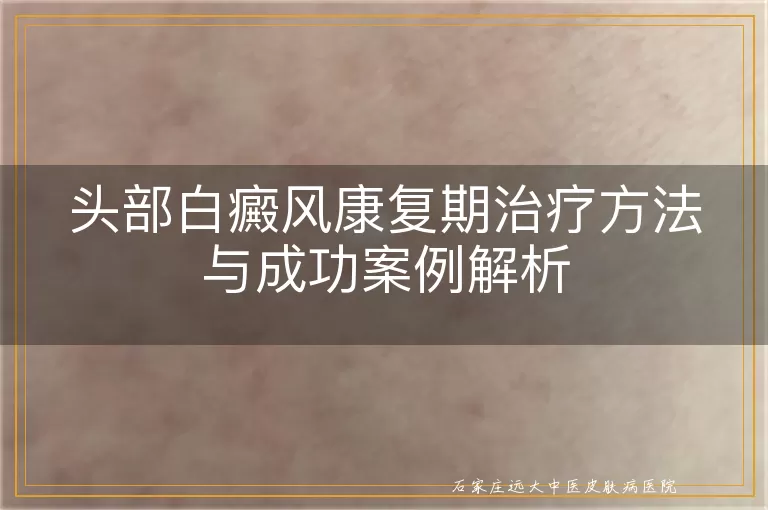 头部白癜风康复期治疗方法与成功案例解析