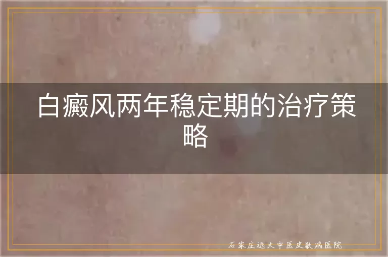 白癜风两年稳定期的治疗策略