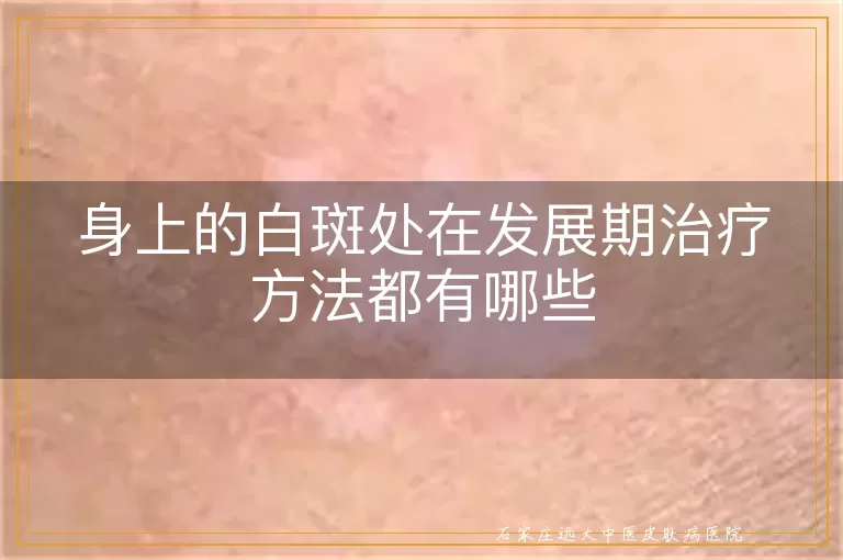 身上的白斑处在发展期治疗方法都有哪些