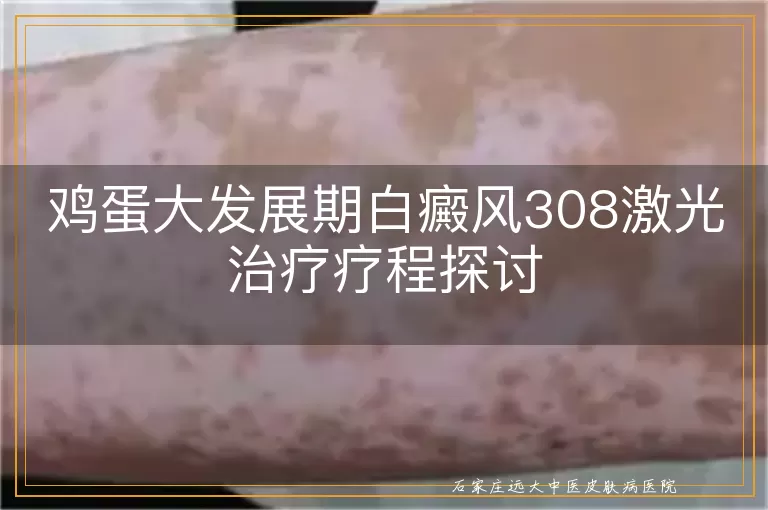 鸡蛋大发展期白癜风308激光治疗疗程探讨