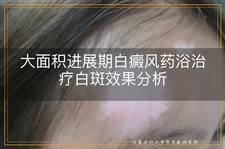 大面积进展期白癜风药浴治疗白斑效果分析