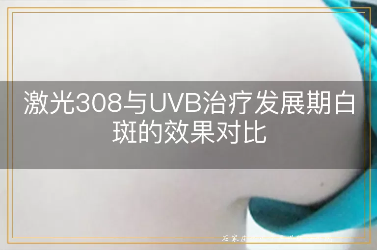 激光308与UVB治疗发展期白斑的效果对比