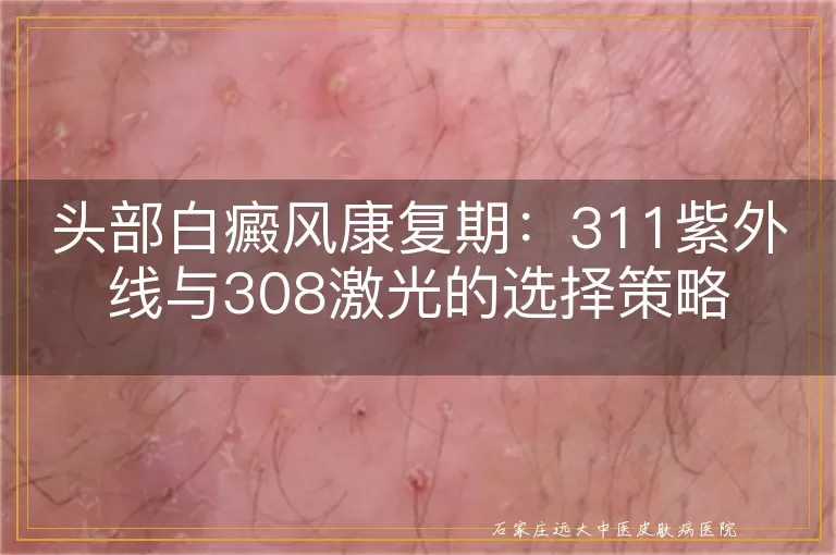 头部白癜风康复期：311紫外线与308激光的选择策略
