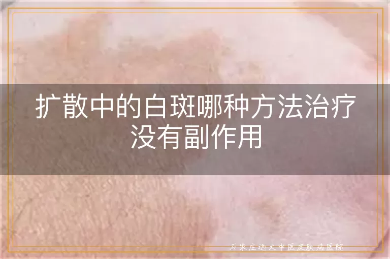 扩散中的白斑哪种方法治疗没有副作用