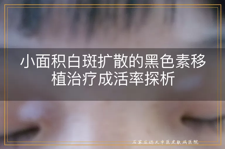 小面积白斑扩散的黑色素移植治疗成活率探析