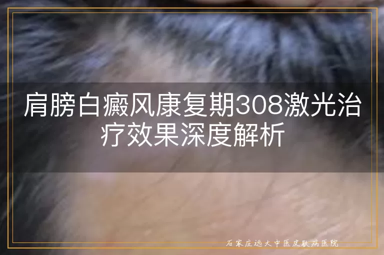 肩膀白癜风康复期308激光治疗效果深度解析