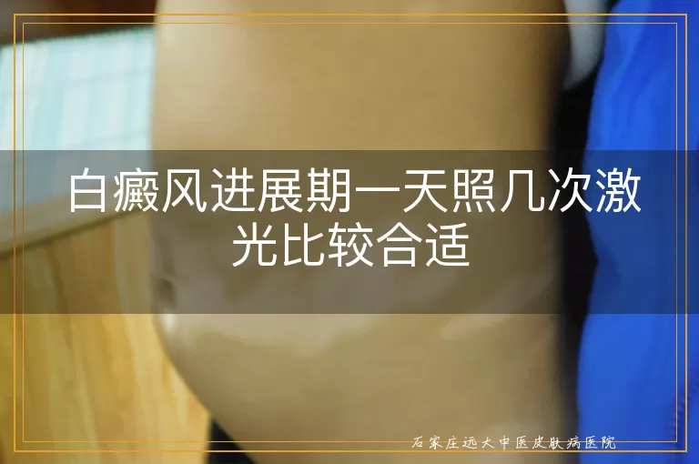 白癜风进展期一天照几次激光比较合适