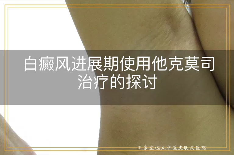 白癜风进展期使用他克莫司治疗的探讨