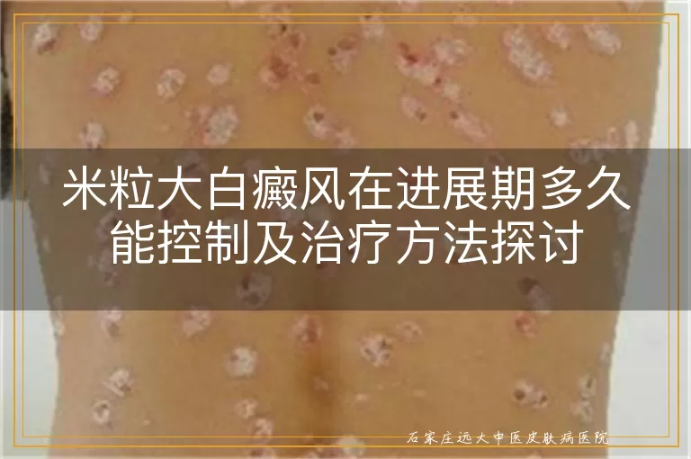 米粒大白癜风在进展期多久能控制及治疗方法探讨