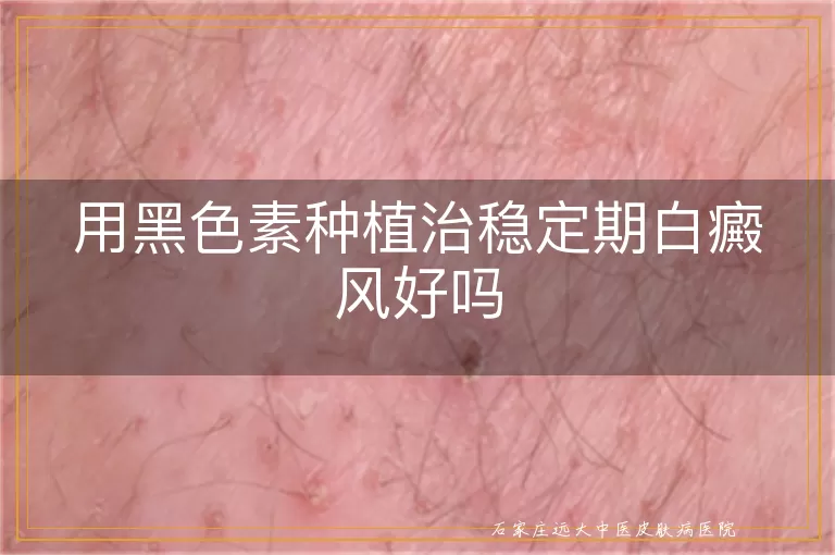 用黑色素种植治稳定期白癜风好吗