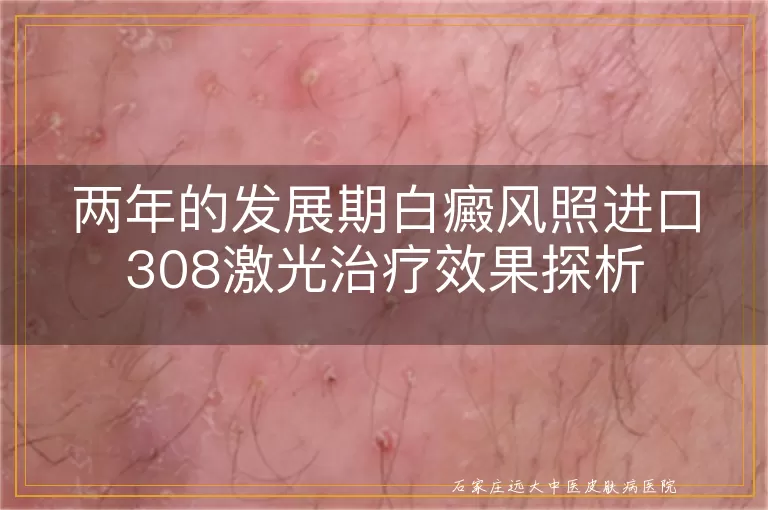 两年的发展期白癜风照进口308激光治疗效果探析