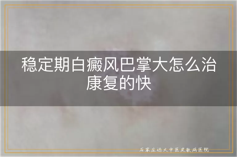 稳定期白癜风巴掌大怎么治康复的快