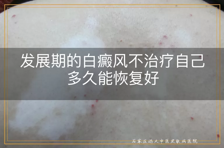 发展期的白癜风不治疗自己多久能恢复好