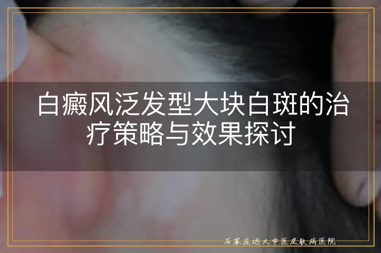 白癜风泛发型大块白斑的治疗策略与效果探讨