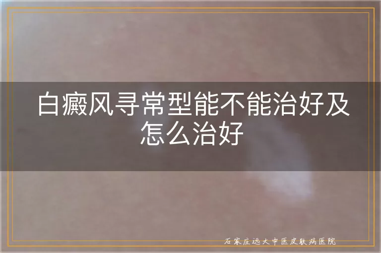 白癜风寻常型能不能治好及怎么治好