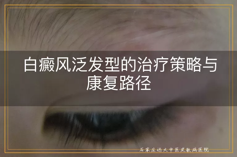 白癜风泛发型的治疗策略与康复路径