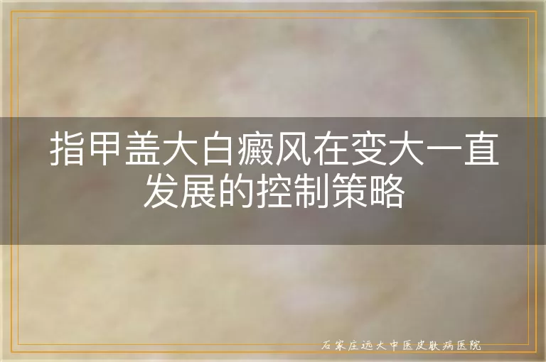 指甲盖大白癜风在变大一直发展的控制策略