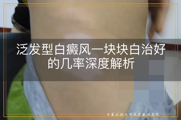 泛发型白癜风一块块白治好的几率深度解析