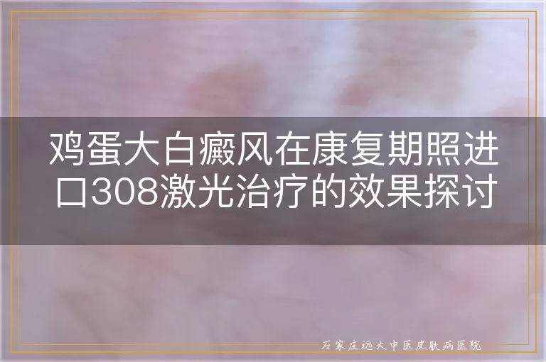 鸡蛋大白癜风在康复期照进口308激光治疗的效果探讨