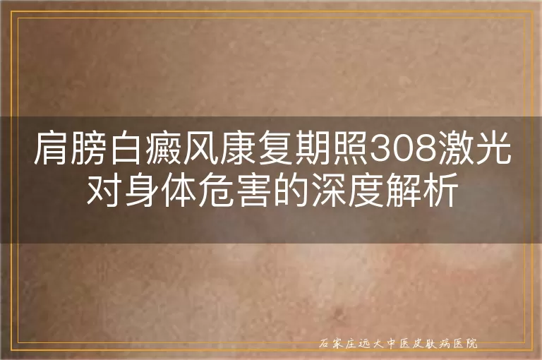 肩膀白癜风康复期照308激光对身体危害的深度解析