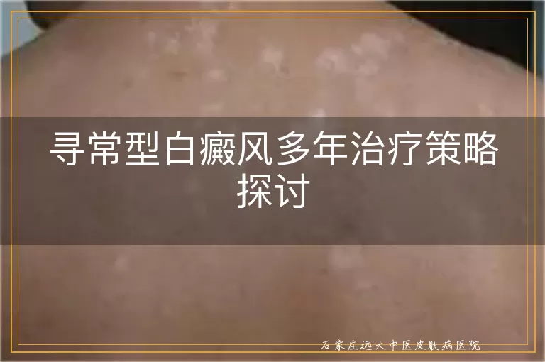 寻常型白癜风多年治疗策略探讨