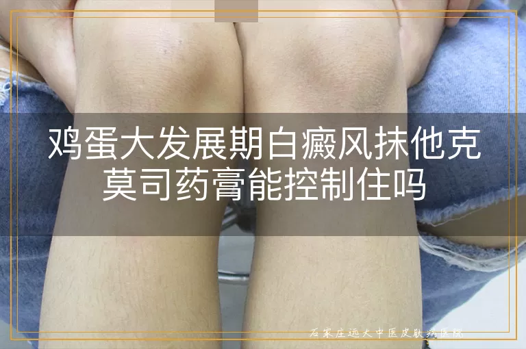鸡蛋大发展期白癜风抹他克莫司药膏能控制住吗